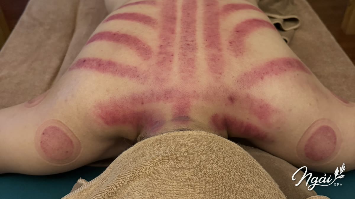 Cạo gió tại Ngải Spa Hà Nội